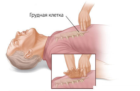 Техника и порядок проведения сердечно-легочной реанимации при дтп