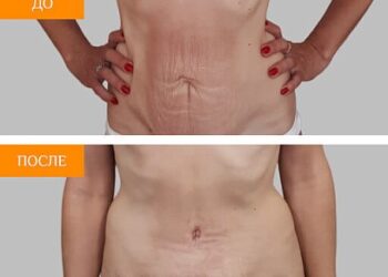 Разница между липосакцией и абдоминопластикой